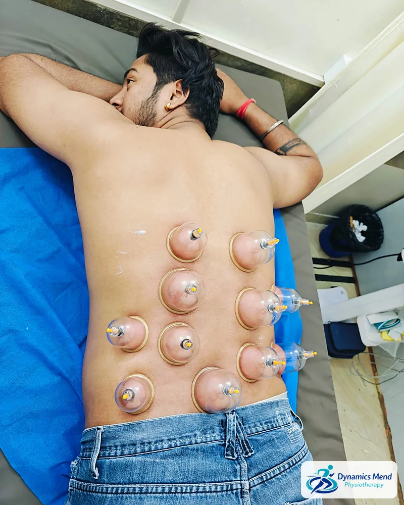 Cupping cups in two rows along the lower back muscles of a patient at Dynamics Mend, Noida