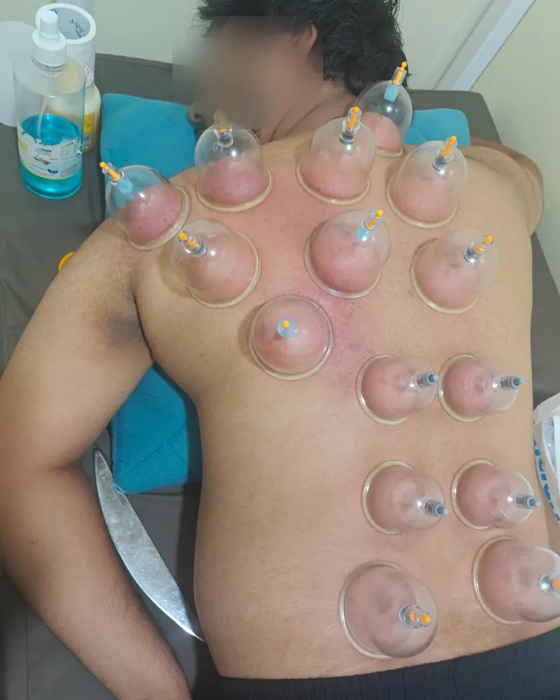 Suction cups placed across a patient's upper back and shoulders during dry cupping at Dynamics Mend, Sector 52 Noida