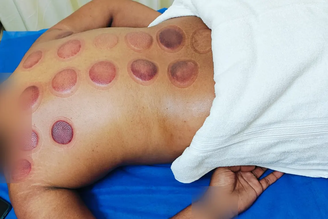 Round cupping marks on a patient's back right after a dry cupping session at Dynamics Mend Noida