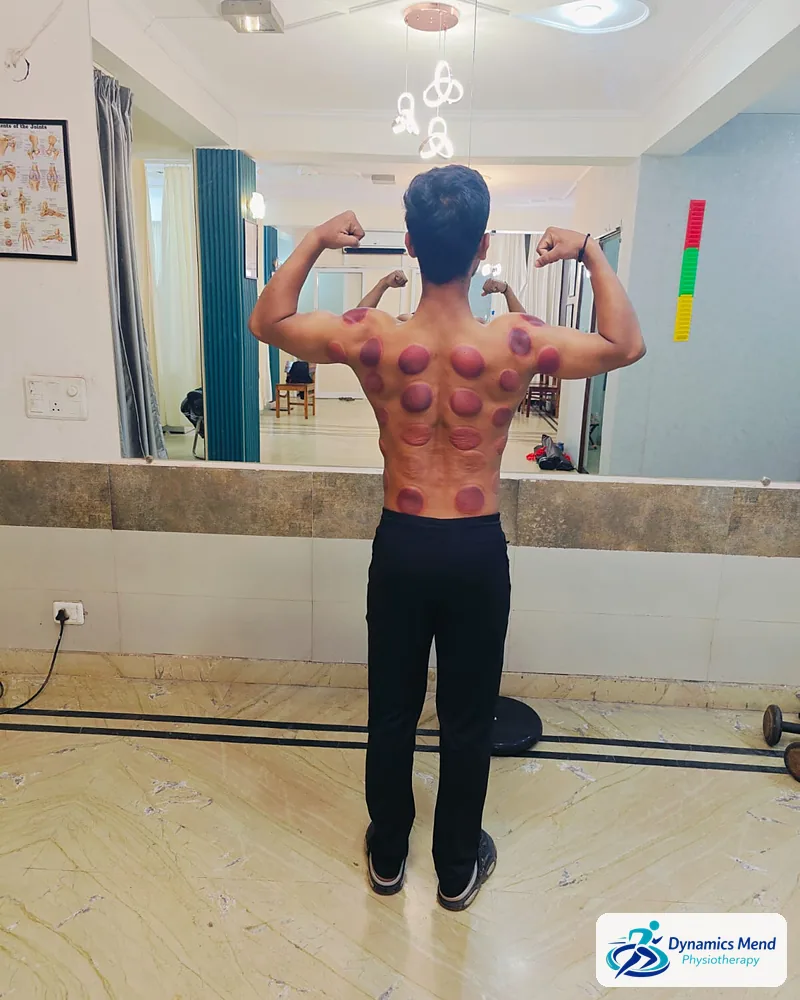 Patient flexing with cupping marks on the back after a session at Dynamics Mend clinic, Noida