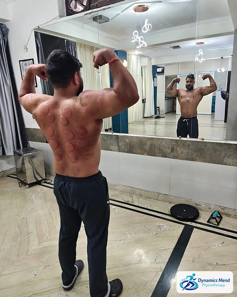 Patient flexing after a back cupping session in the Dynamics Mend exercise area, Sector 52 Noida