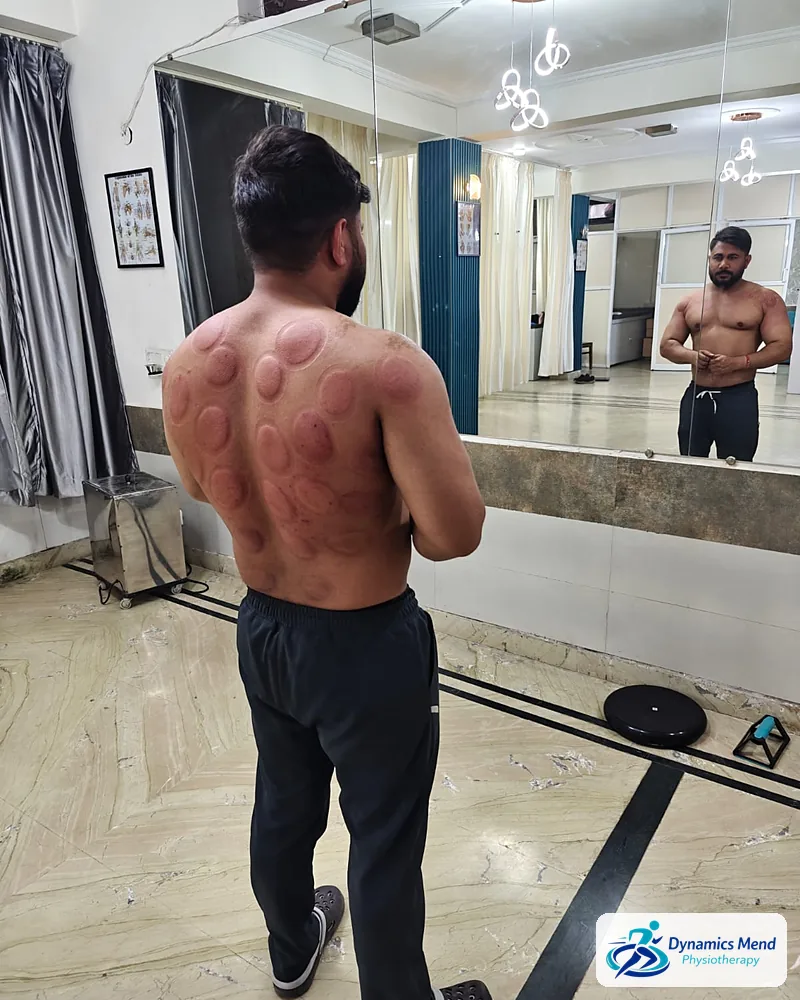 Cupping marks across a patient's shoulders and upper back, standing in the Dynamics Mend exercise area, Sector 52 Noida