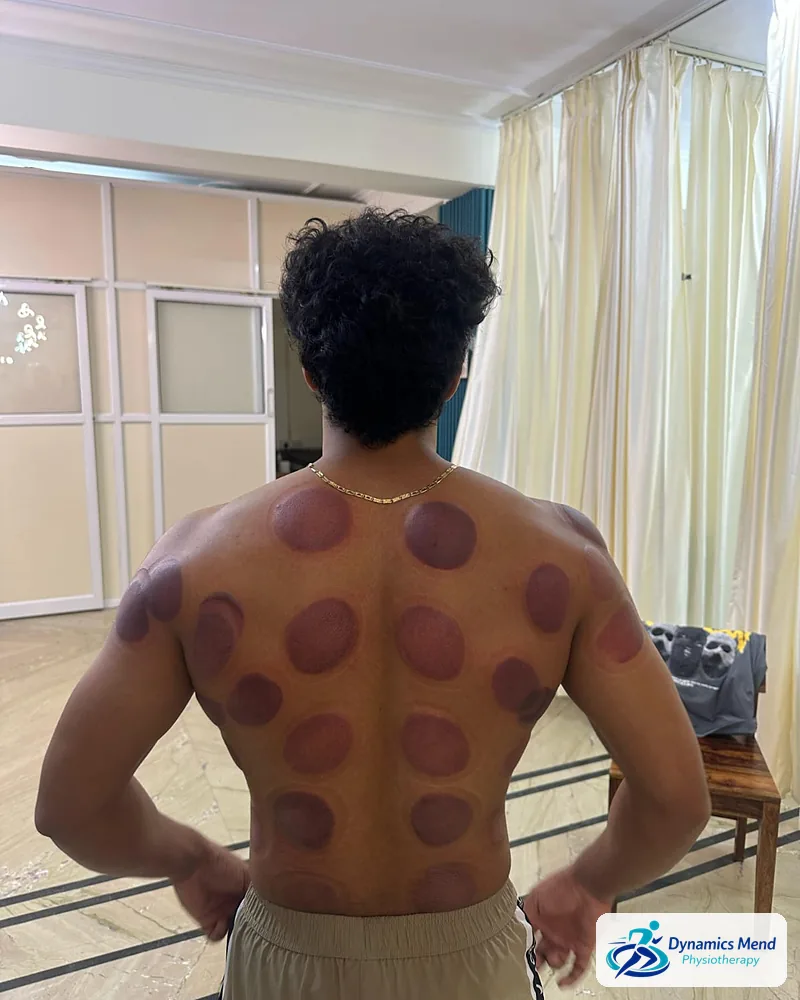 Round cupping marks across a patient's upper and mid back after dry cupping at Dynamics Mend Noida