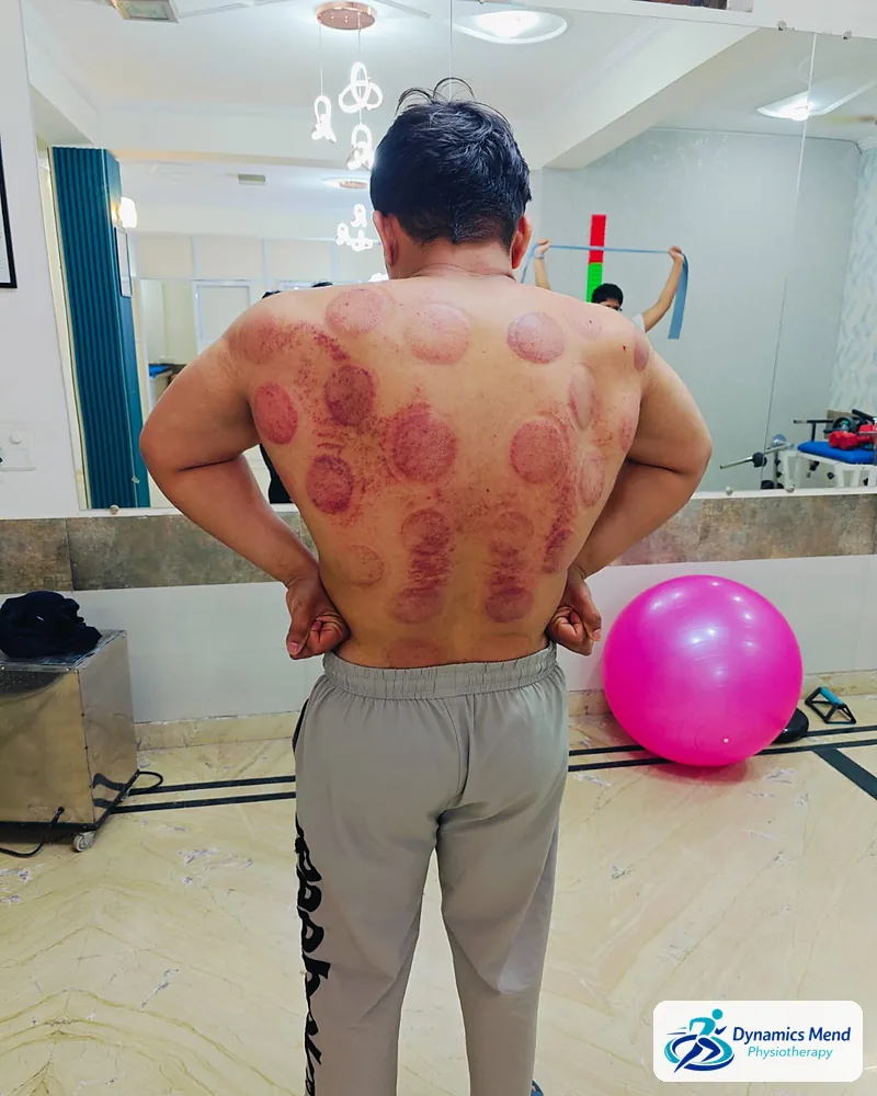 Dark cupping marks across a patient's back after dry cupping at Dynamics Mend, Sector 52 Noida