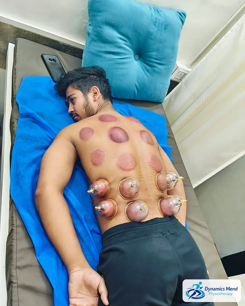 Dry cupping cups on a patient's lower back with round marks on the upper back, at Dynamics Mend Sector 52 Noida