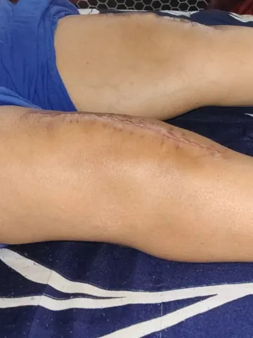 Both knees after knee replacement surgery, during home physiotherapy in Noida