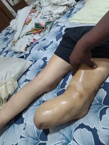 Physiotherapist massaging a patient's knee with oil during a home visit in Noida