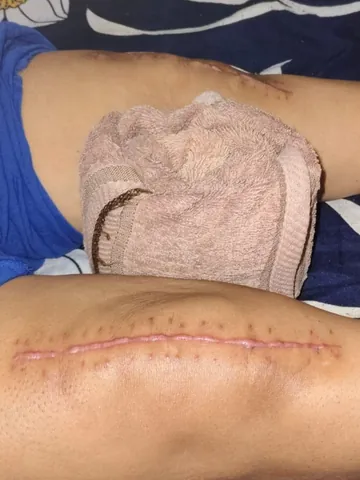 Healing knee replacement scar with a towel roll under the knee during home physiotherapy in Noida