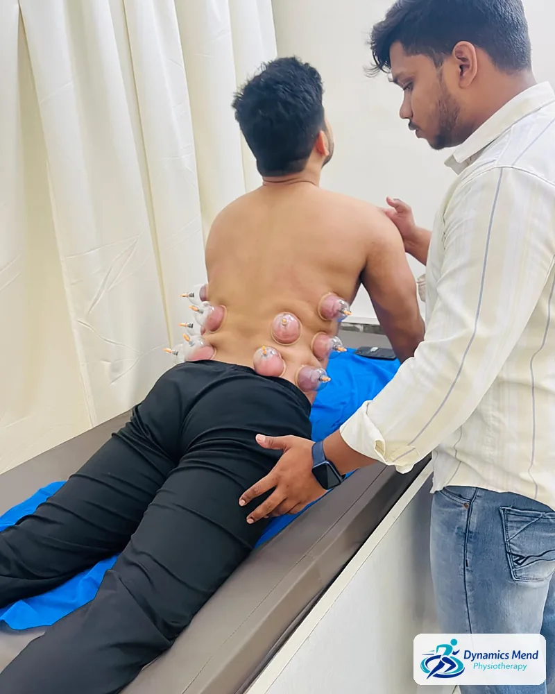 Physiotherapist placing cupping cups on a seated patient's lower back at Dynamics Mend physiotherapy clinic, Noida