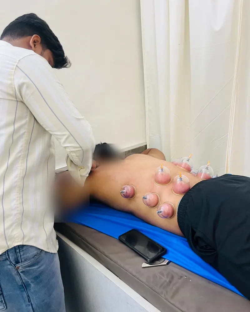 Physiotherapist placing suction cups on a patient's lower back during a cupping therapy session in Noida