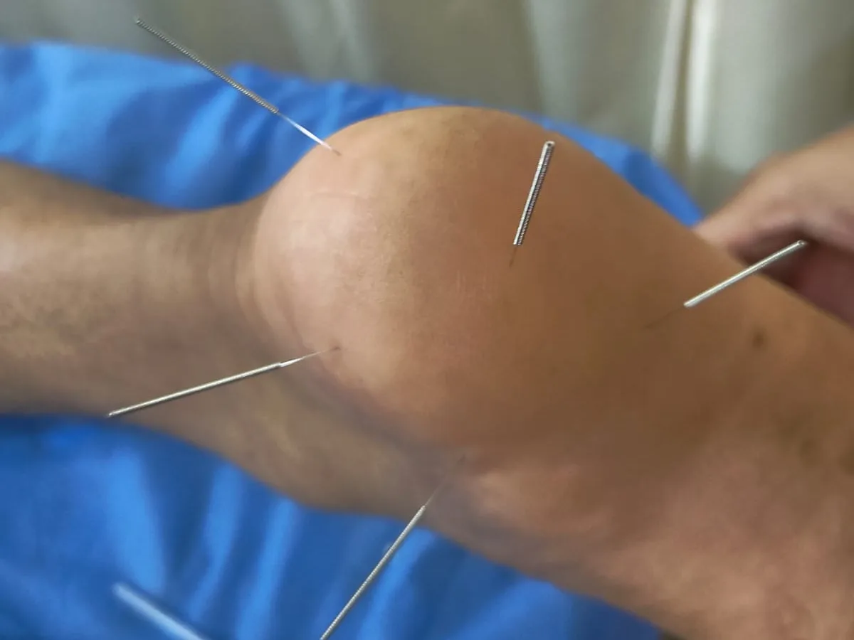 Real trigger point dry needling session on a knee at Dynamics Mend Sector 52 Noida, sterile single-use needles
